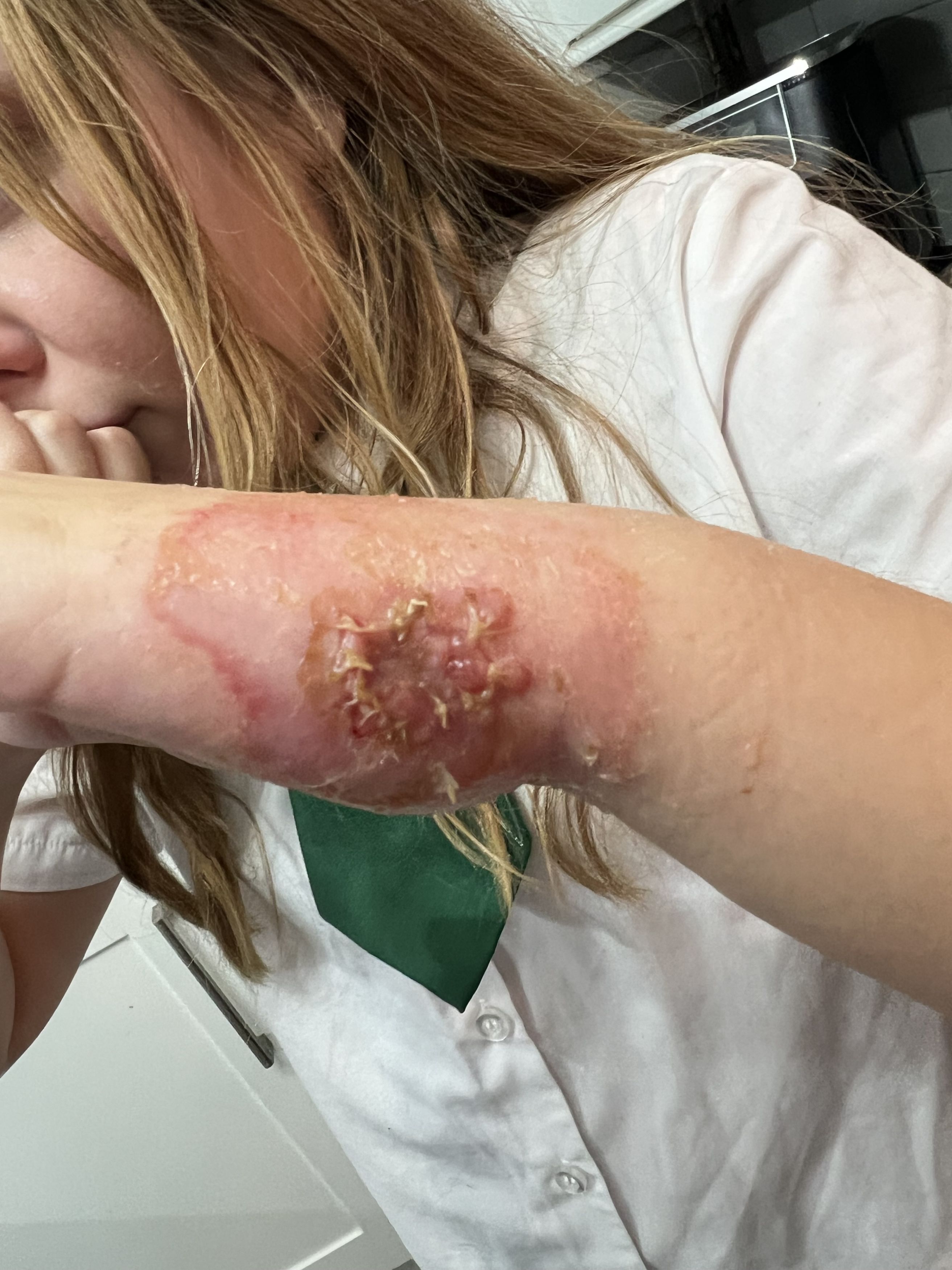 Chloe's arm was severely burned after using nail glue purchased from Temu